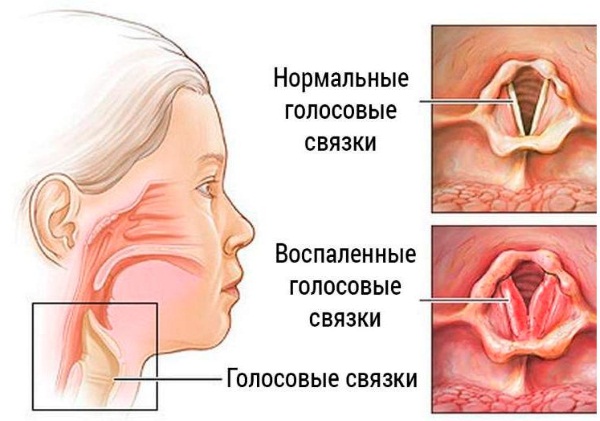 Хлорид натрия - физраствор для ингаляций, промывания носа. Инструкция применения