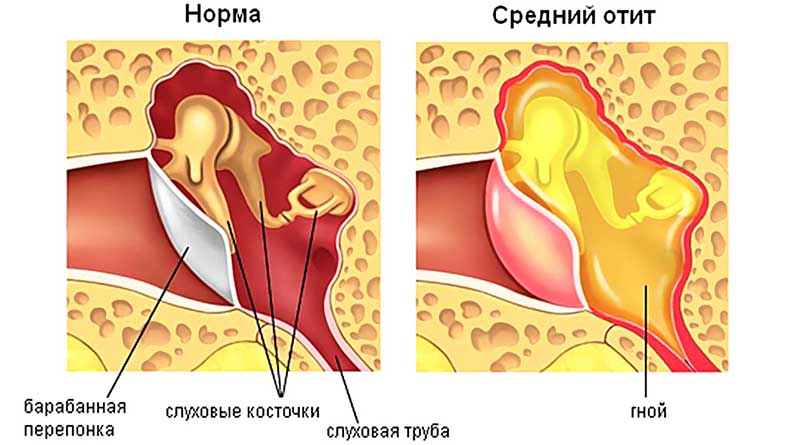 Хлорид натрия - физраствор для ингаляций, промывания носа. Инструкция применения