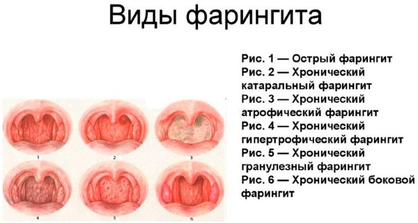 Хронический фарингит. Симптомы и лечение у взрослых, препараты, народные средства