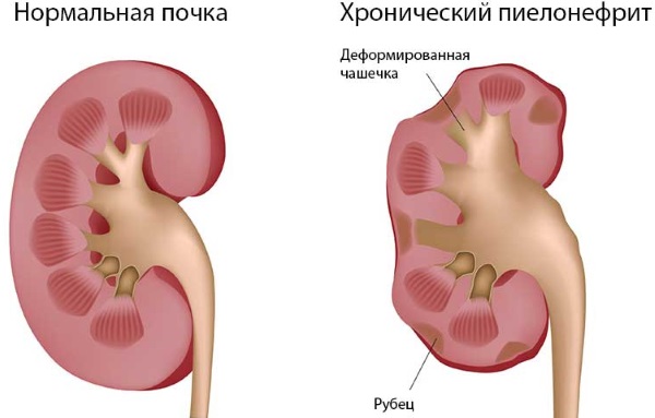 Хронический пиелонефрит у женщин. Симптомы и лечение народными средствами, препараты, диета