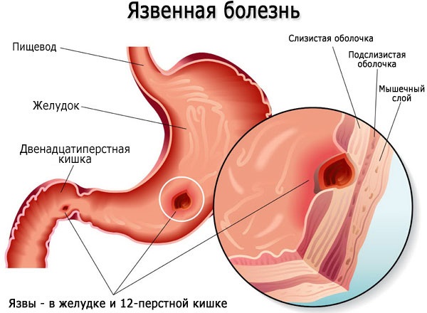 Как быстро избавиться от поноса, чем остановить в домашних условиях. Препараты, народные средства