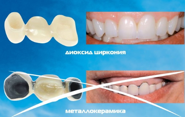 Керамические вкладки на зубы. Что это такое, фото, цена, отзывы врачей