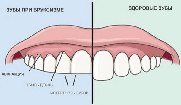 Керамические вкладки на зубы. Что это такое, фото, цена, отзывы врачей