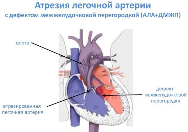 Легочная артерия. Где находится, норма давления, симптомы и лечение тромбоза, стеноза, гипертензия. Клинические рекомендации