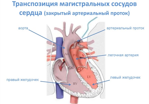 Легочная артерия. Где находится, норма давления, симптомы и лечение тромбоза, стеноза, гипертензия. Клинические рекомендации