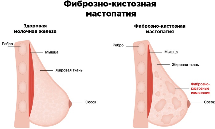 Мастопатия молочной железы. Симптомы, признаки, лечение народными средствами, травы