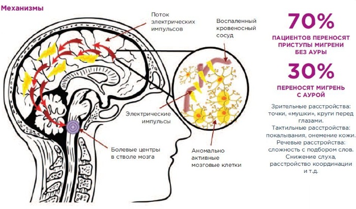 Мигрень. Симптомы и лечение у женщин таблетками, народные средства, сколько дней болит голова