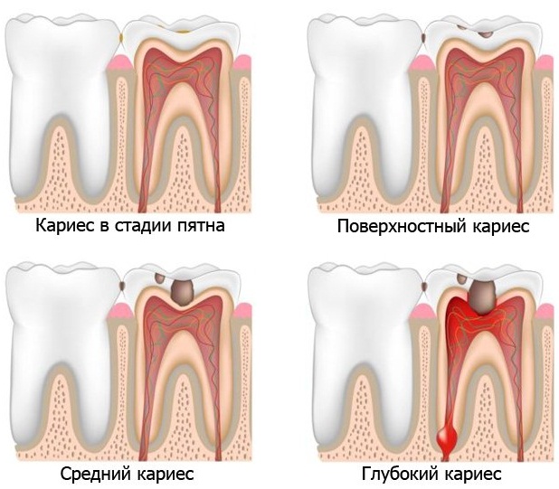 Острый пиелонефрит у женщин. Симптомы и лечение, причины и последствия