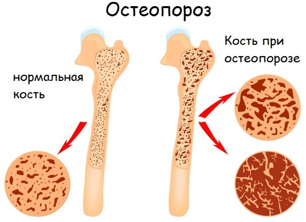 Недостаток фтора в организме у женщин, мужчин. Симптомы, что развивается, к чему приводит