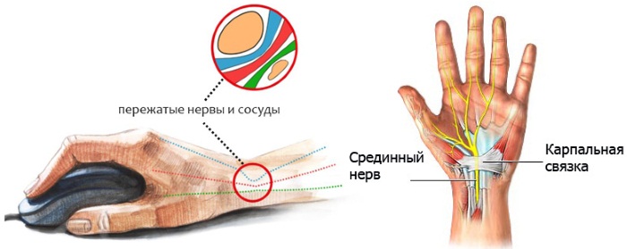 Почему немеет рука левая/правая, кисть, кончики пальцев, от локтя по ночам во сне. Что делать, лечение