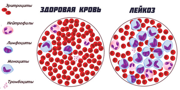 Передозировка витамина Д. Симптомы у взрослых, детей. Чем лечить