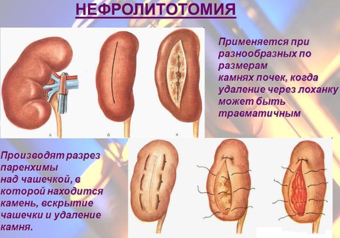 Песок в почках. Причины, симптомы и лечение у женщин