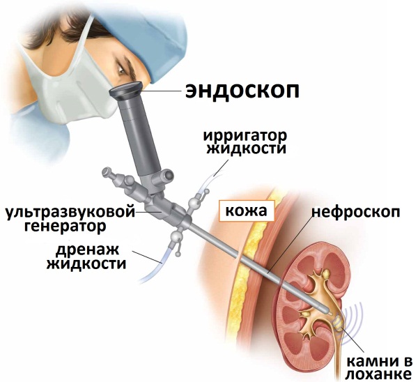 Песок в почках. Причины, симптомы и лечение у женщин