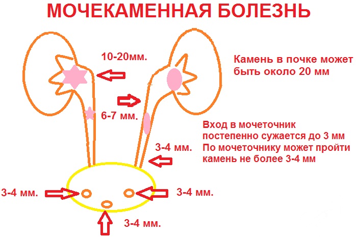 Песок в почках. Причины, симптомы и лечение у женщин