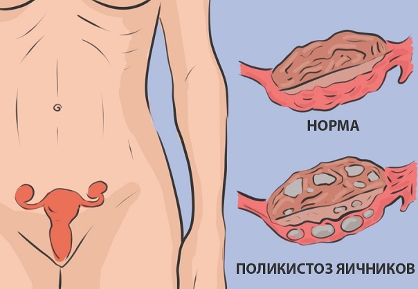 Почему не идут месячные. Причины, кроме беременности, что делать