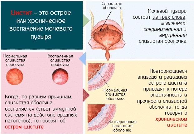 Где почки у человека фото как болят