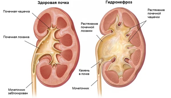 Почки у человека: расположение, где находятся, строение, функции, как работают, болезни