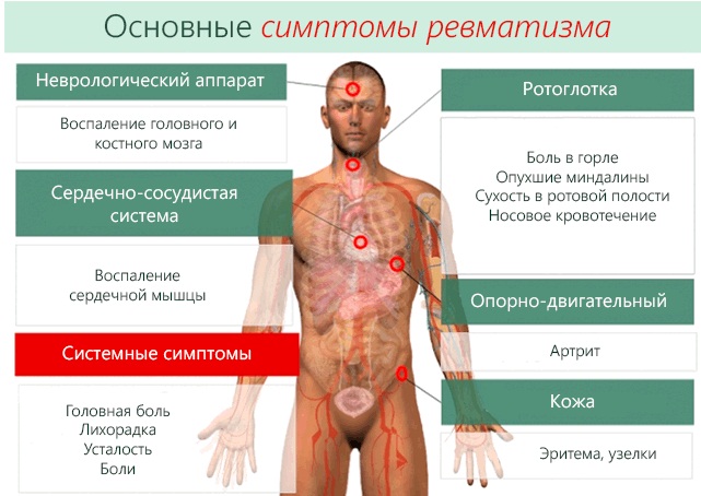 Ревматизм. Симптомы и лечение у взрослых, детей, народные средства, препараты