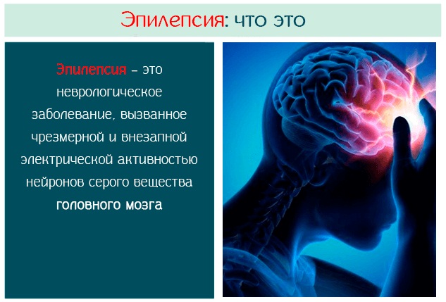 Эпилепсия. Симптомы с потерей и без сознания, стадии, как распознать у взрослого, лечение