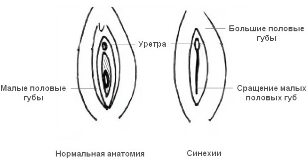 Синехии у девочек и мальчиков. Фото, причины и лечение крайней плоти, половых губ