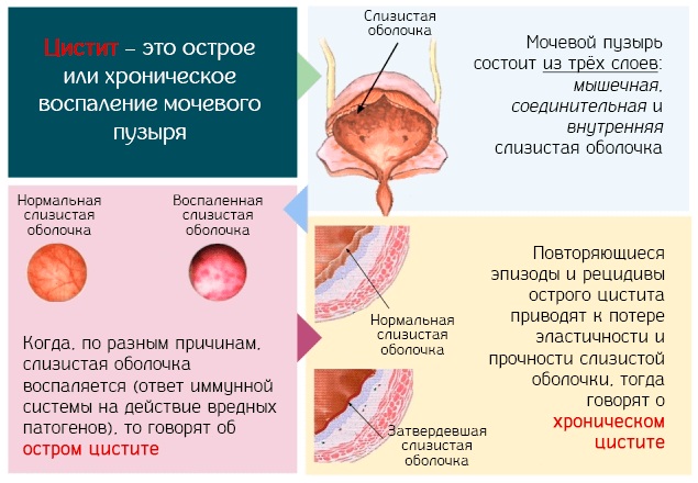 Лечение трихомонады у женщин препараты схема