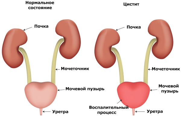 Трихомониаз. Лечение у женщин, курс, препараты, чем опасно