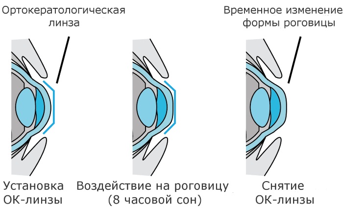 Цветные линзы с диоптриями. Какие лучшие однодневные, для астигматизма. Названия, цены, отзывы