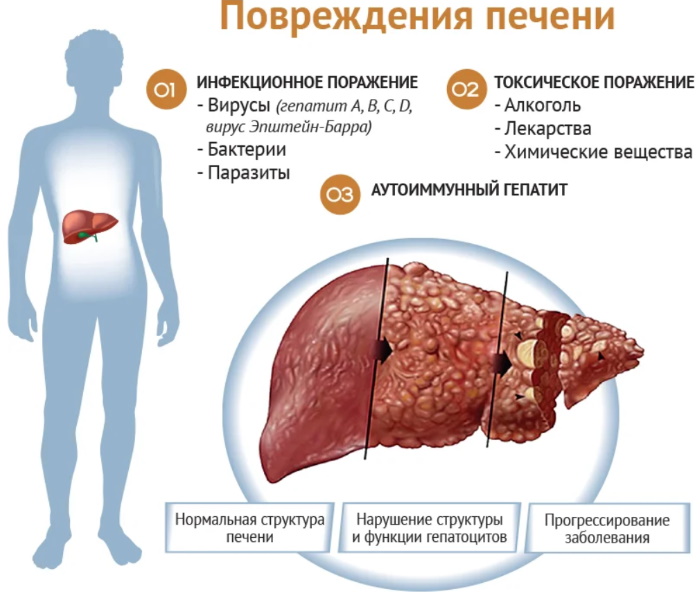 Заболевания печени у женщин. Причины, симптомы и лечение