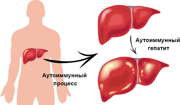 Заболевания печени у женщин. Причины, симптомы и лечение