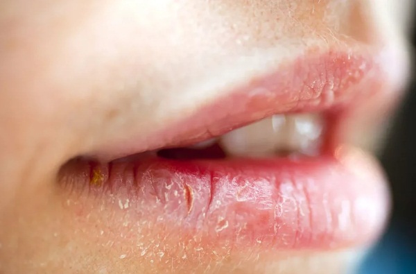 Как вылечить раздражение на губах