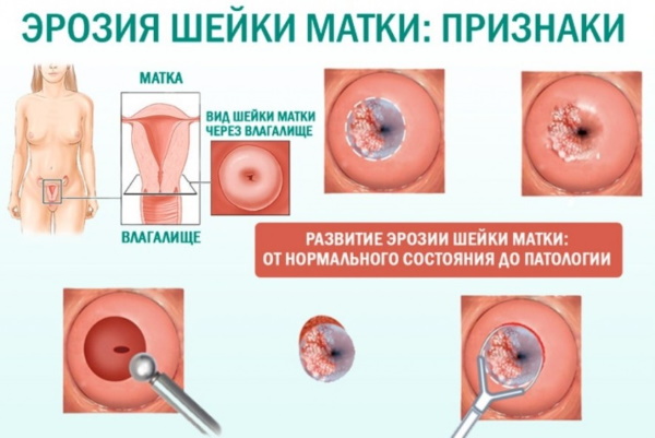 Эрозия шейки матки. Лечение облепиховым маслом, свечами, народными средствами, гомеопатией у нерожавших, при беременности, гв