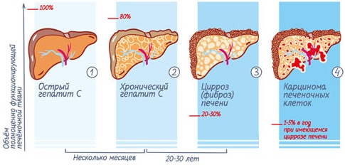 Гепатит С. Симптомы и лечение у женщин, признаки, температура, как передается