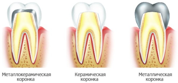 Коронки металлокерамика на зуб. Какие лучше, фото, как ставят, цены и отзывы