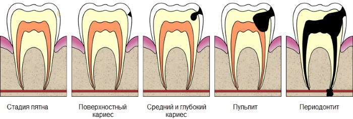 Как убрать черные полосы на зубах у ребенка