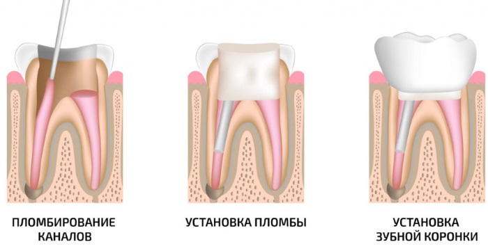 Коронки металлокерамика на зуб. Какие лучше, фото, как ставят, цены и отзывы