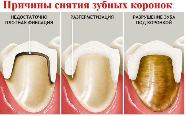 Коронки металлокерамика на зуб. Какие лучше, фото, как ставят, цены и отзывы