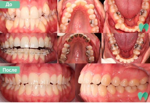 Лингвальные брекеты фото на зубах