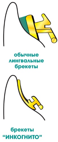 Установка брекетов. Этапы, виды, стоимость процедуры в стоматологии