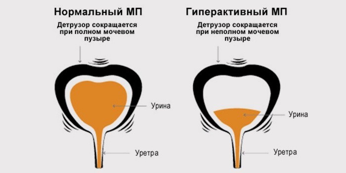 Нейрогенный мочевой пузырь у мужчин, детей, женщин. Лечение, клинические рекомендации