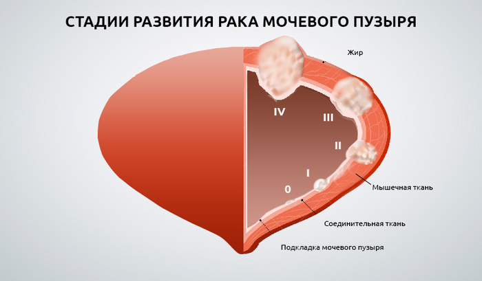 Нейрогенный мочевой пузырь у мужчин, детей, женщин. Лечение, клинические рекомендации