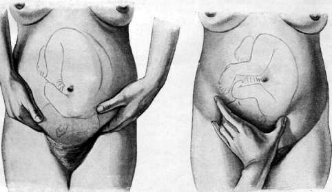 Приемы Леопольда-Левицкого в акушерстве 4. Алгоритм наружного исследования, тонуса матки, предлежащей части