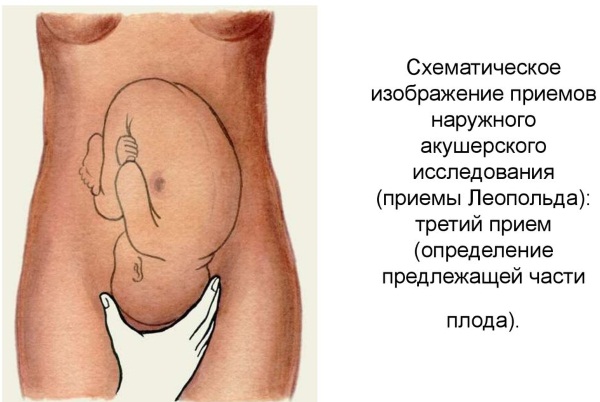 Приемы Леопольда-Левицкого в акушерстве 4. Алгоритм наружного исследования, тонуса матки, предлежащей части