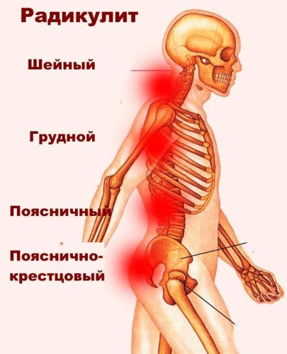 Поясничный радикулит. Симптомы и лечение, народные средства, медикаменты