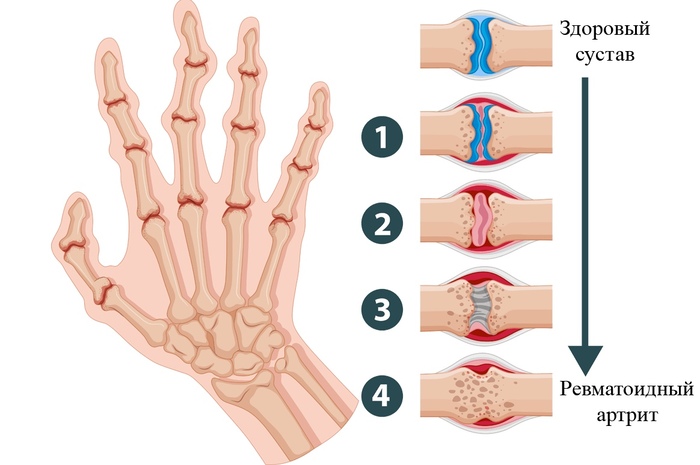 Ревматоидный артрит. Симптомы и лечение, препараты, народные средства