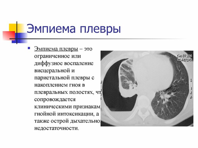 Туберкулез. Симптомы, признаки, стадии и лечение у взрослых. Народные средства, медикаменты