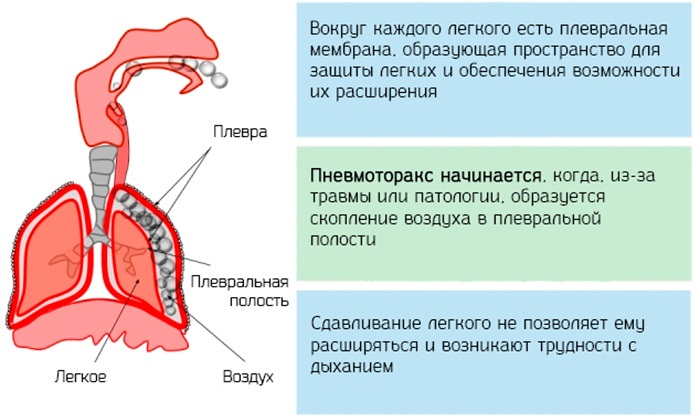 Туберкулез у ребенка. Симптомы, как передается, лечение