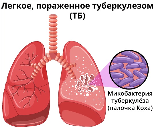 Туберкулез у ребенка. Симптомы, как передается, лечение