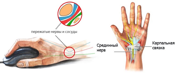 Туннельный синдром запястья кисти. Симптомы и лечение народными средствами, операция