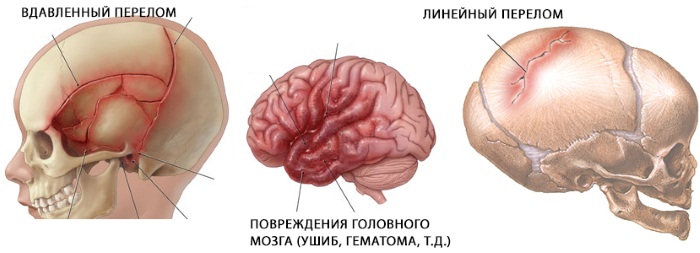 Что делать при ушибе головы, если ударился и болит, тошнит, кружится, шишка