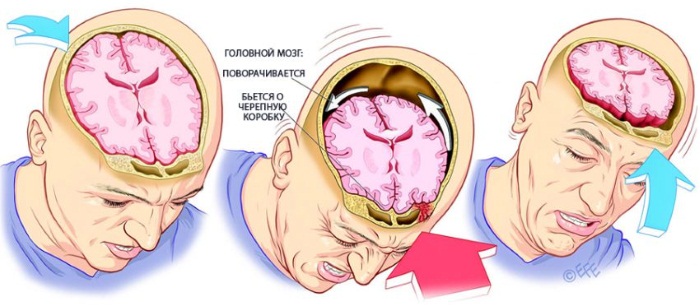 Что делать при ушибе головы, если ударился и болит, тошнит, кружится, шишка